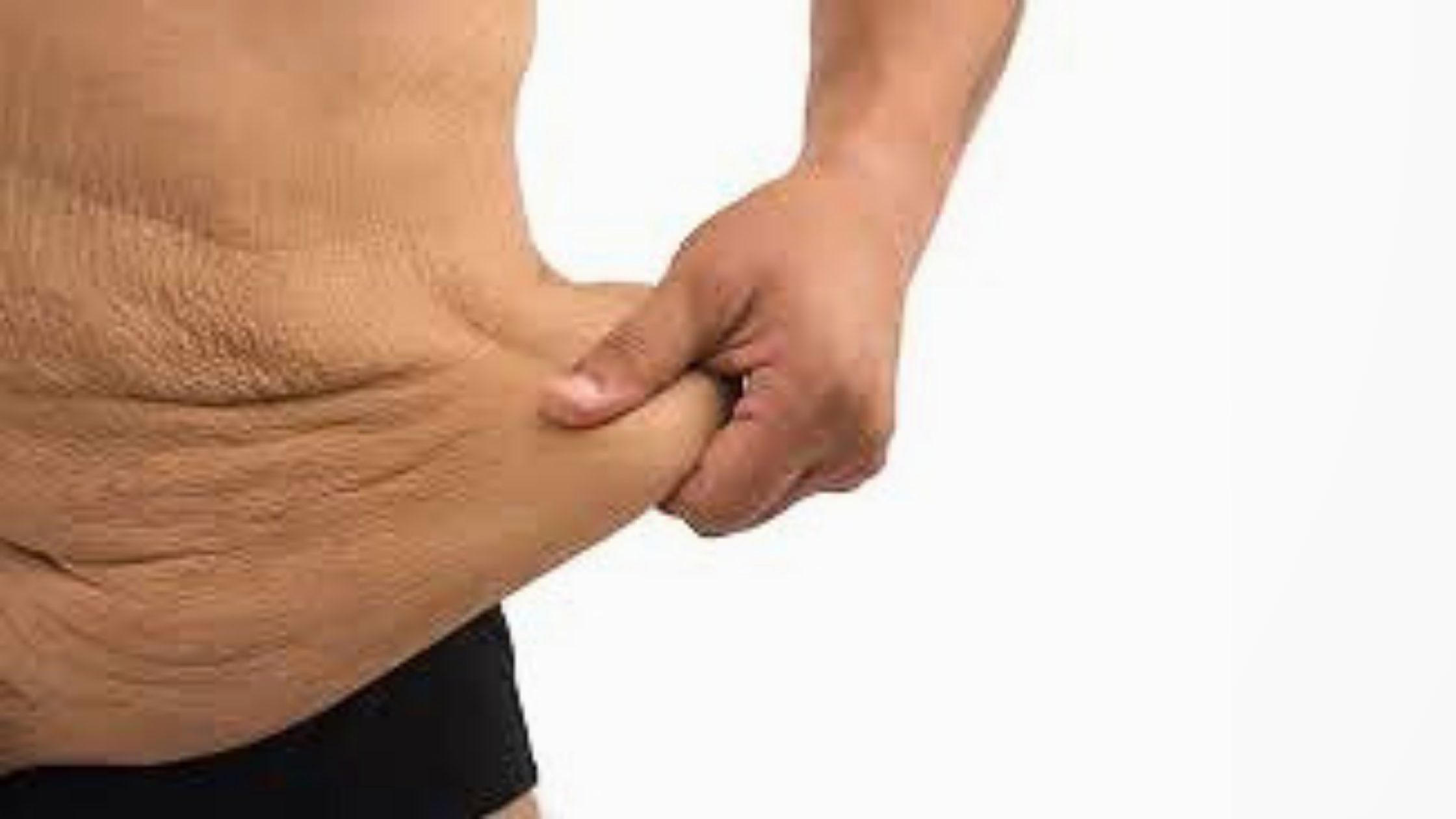Loose Skin: Obesity’s Badge of Courage